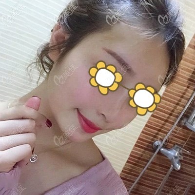 热玛吉提拉术后20天还有点轻微肿胀但提拉明显 热玛吉提拉术后20天还有点轻微肿胀但提拉明显