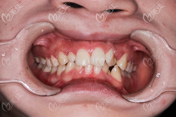 牙齿重度拥挤图片 牙齿重度拥挤图片