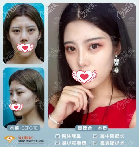 沈阳杏林鼻综合真人案例前后对比照 沈阳杏林鼻综合真人案例前后对比照