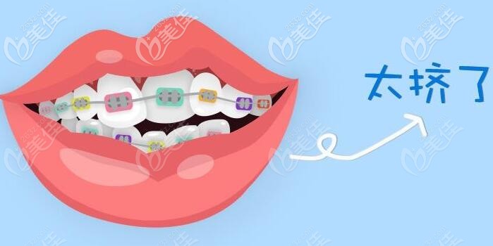 牙齿排列拥挤程度图 牙齿排列拥挤程度图