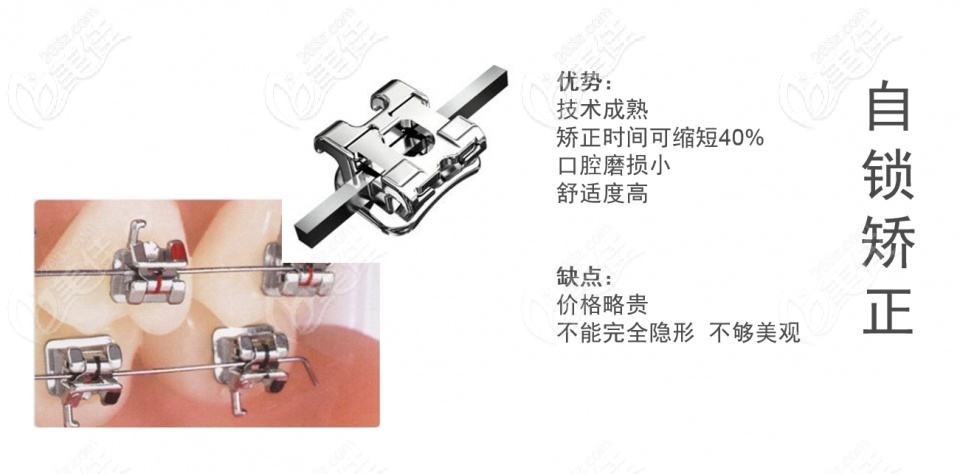 海口微笑口腔金属自锁矫正器 海口微笑口腔金属自锁矫正器