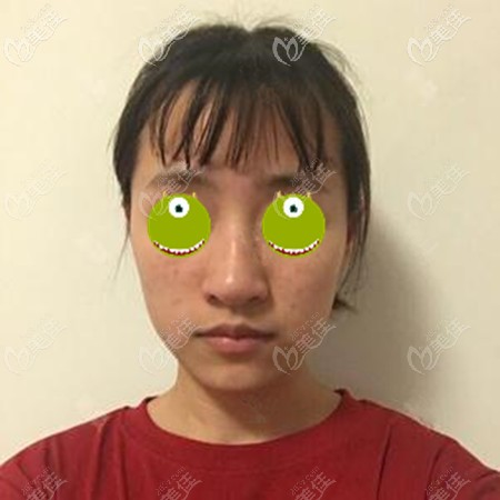 膨体隆鼻失败后找到了范浚泽医生 膨体隆鼻失败后找到了范浚泽医生