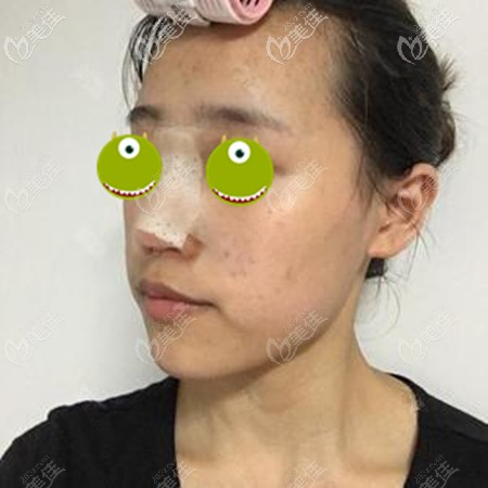 在郑大<!--<i data=20240703-sp></i>-->院做鼻修复一周后 在郑大<!--<i data=20240703-sp></i>-->院做鼻修复一周后