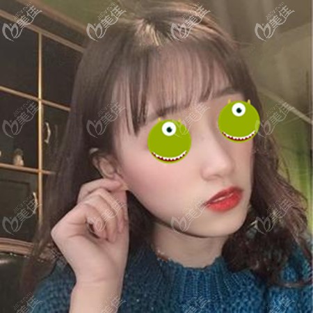 隆鼻失败后将膨体换成了生科硅胶假体 隆鼻失败后将膨体换成了生科硅胶假体