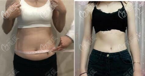 在石家庄雅芳做腰腹环吸前后对比照片