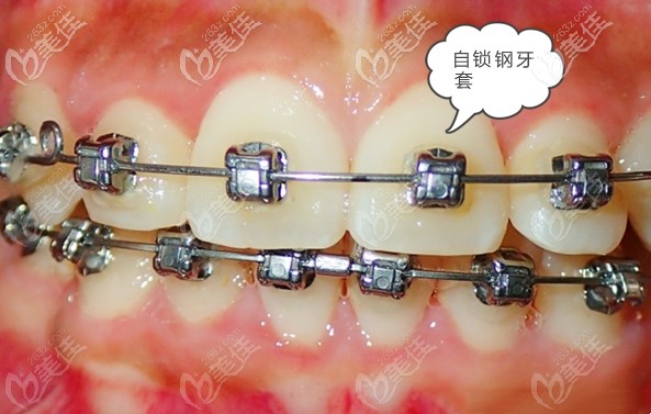 我的自锁钢牙套矫正经历 我的自锁钢牙套矫正经历