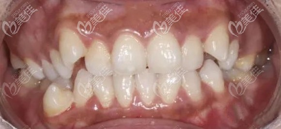 我是牙齿咬合错乱 我是牙齿咬合错乱