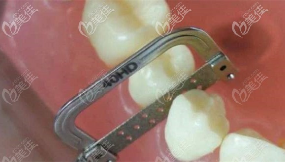 矫治牙齿咬合错乱还做了片切 矫治牙齿咬合错乱还做了片切