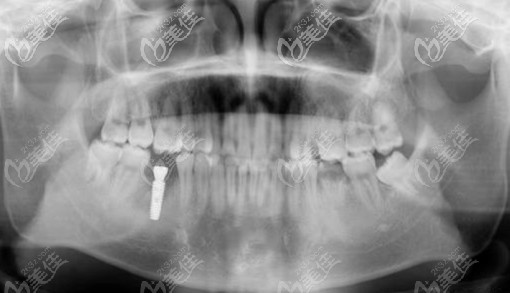 右下第一磨牙缺失选韩国登腾lmplantium种植体的效果也不错哦