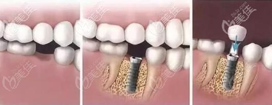 种植牙修复过程