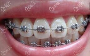 金属自锁钢牙套