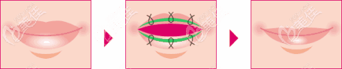 缩唇手术过程
