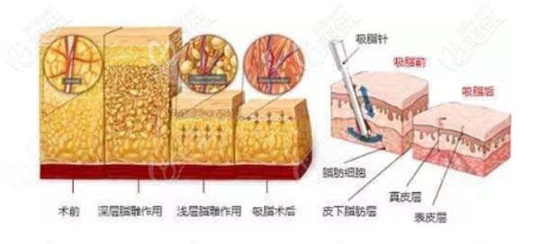 李弋院长的维密脂雕术优势 李弋院长的维密脂雕术优势