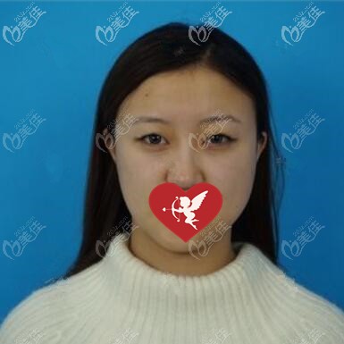 做埋线双眼皮术前照 做埋线双眼皮术前照