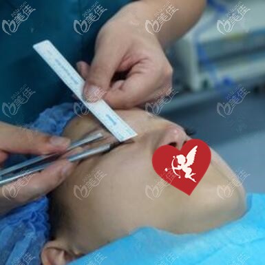 做埋线双眼皮术前画线设计 做埋线双眼皮术前画线设计