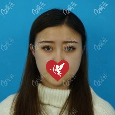 埋线双眼皮术后10天恢复效果照 埋线双眼皮术后10天恢复效果照