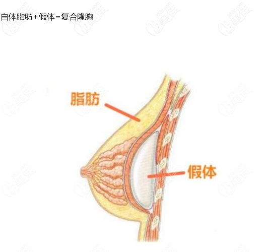 复合隆胸的缺点是什么 复合隆胸的缺点是什么