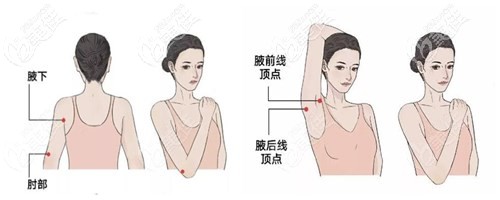 手臂吸脂分布图 手臂吸脂分布图