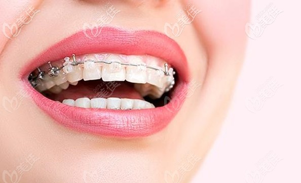 在自贡新桥口腔矫正牙齿可立减千元