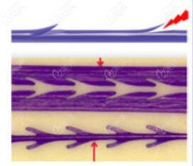 美国强生鱼骨线介绍 美国强生鱼骨线介绍
