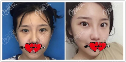 美国强生鱼骨线埋线提升一年效果对比图 美国强生鱼骨线埋线提升一年效果对比图