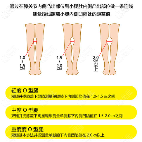 O型腿不同程度的自测方法 O型腿不同程度的自测方法