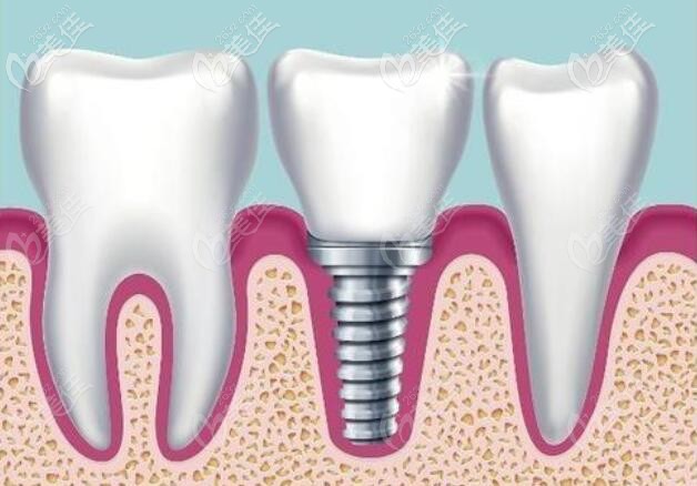 老年人种植牙高吗