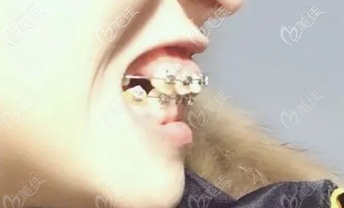 国产金属矫正第10个月 国产金属矫正第10个月