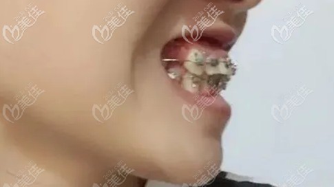 时隔两个月变化也蛮大的 时隔两个月变化也蛮大的