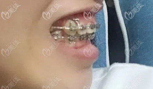 速度太快了,已经没有那么凸了 速度太快了,已经没有那么凸了