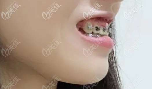 上下牙还得继续收缝 上下牙还得继续收缝