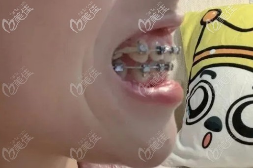 拉虎牙,继续收缝 拉虎牙,继续收缝