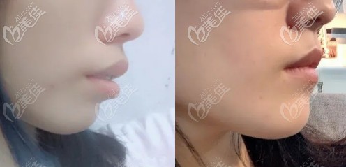 2颗门牙做了烤瓷牙后箍牙成功:我用国产自锁托槽矫正了骨性龅牙