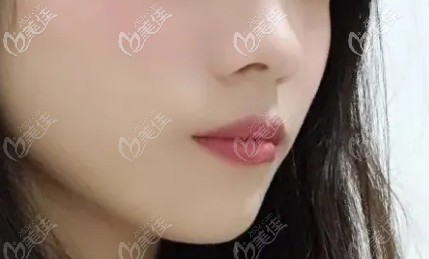 嘴巴突出的部分已经平了 嘴巴突出的部分已经平了