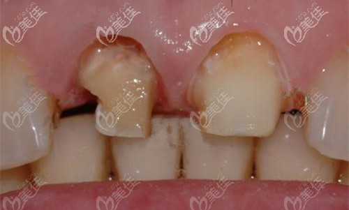 门牙磨小以后做的烤瓷冠 门牙磨小以后做的烤瓷冠