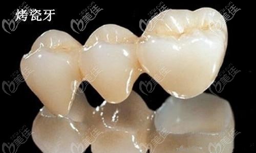 烤瓷牙的出现哪些症状表示该换了呢？