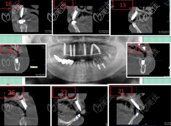 上半口ALL-ON-6即刻负重种植牙
