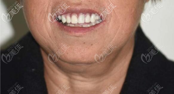三亚鼎点口腔刚做的韩国登腾上颌即刻种植牙修复案例已完成