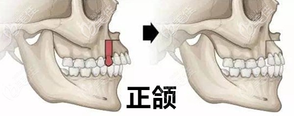 正颌手术示意图