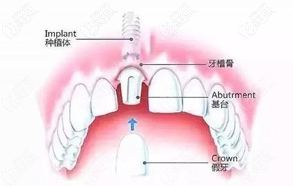 做一颗种植牙的流程图 做一颗种植牙的流程图