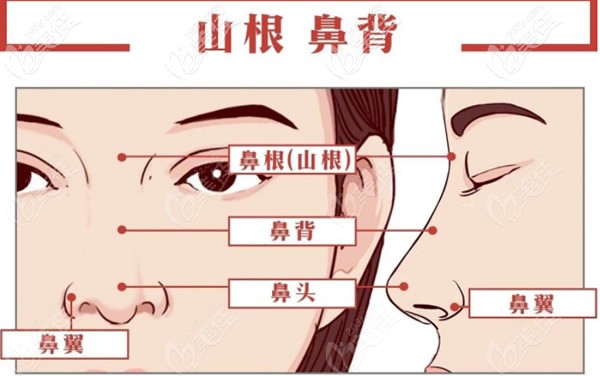 隆鼻后眼角被拉长了 眼睛好难看怎么办 自体软骨隆鼻 美佳网整形问答