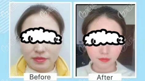 做艾美缇st筋膜再植提升全脸半年效果对比图 做艾美缇st筋膜再植提升全脸半年效果对比图