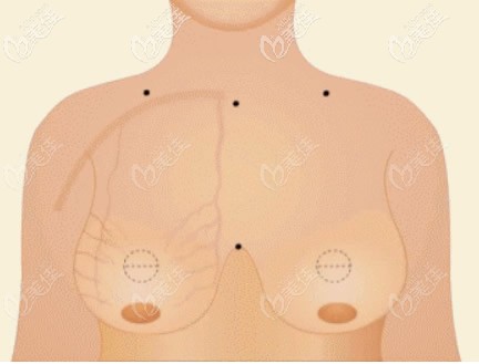 抽脂缩胸会把胸变下垂吗 抽脂缩胸会把胸变下垂吗