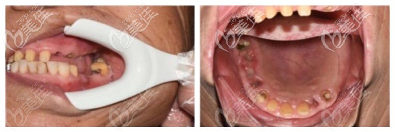 三亚鼎点口腔上半口缺失案例