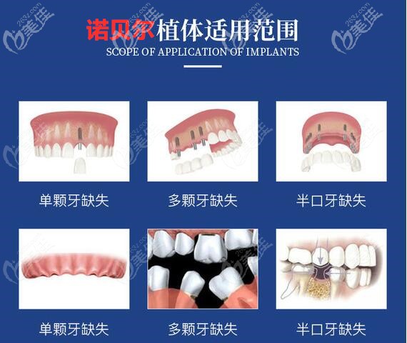 瑞典诺贝尔种植牙的适用范围 瑞典诺贝尔种植牙的适用范围