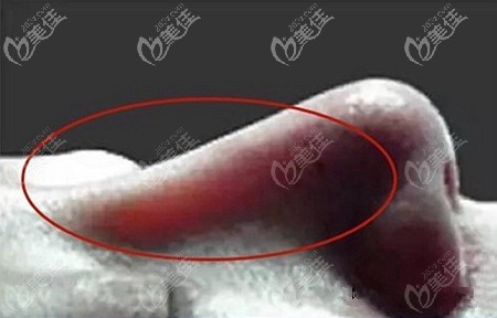 注射乔雅登5号隆鼻后透光的原因