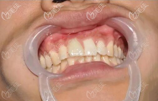 深覆合导致突嘴,戴3M钢丝自锁牙套后的效果惊艳到你了吗