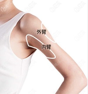 手臂吸脂图解 手臂吸脂图解