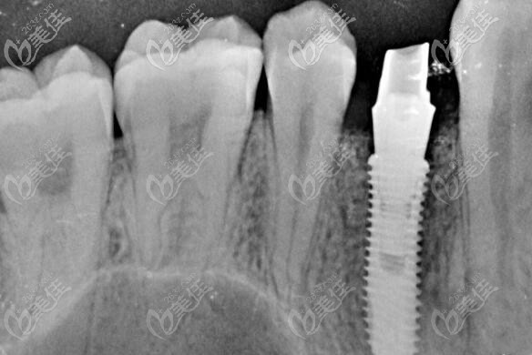 单颗种植牙缺失 单颗种植牙缺失