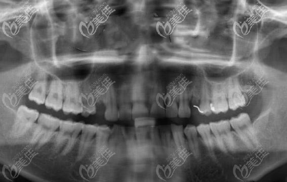 单颗缺失口腔X线片 单颗缺失口腔X线片